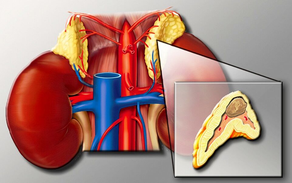 Feochromocitoma for hypertension