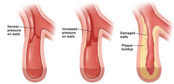 In hypertension, there is a violation of the patency of the vascular bed